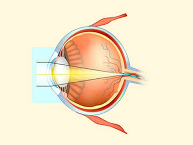 cataract-services