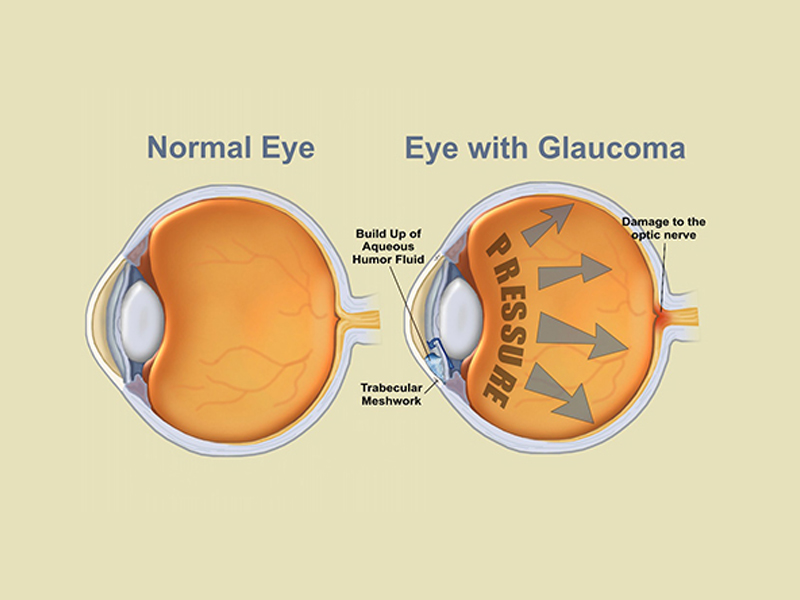 glaucoma-services